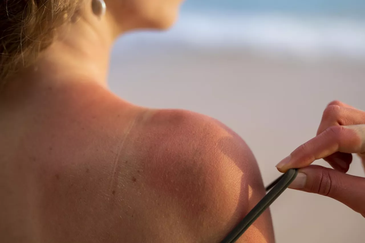Do czasu zagojenia się oparzenia, należy całkowicie unikać słońca, ponieważ spalona skóra jest bardziej podatna na dalsze uszkodzenia.